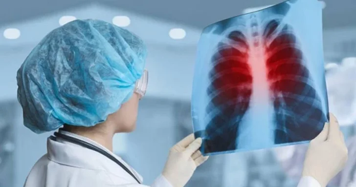 Эффективная борьба с туберкулезом: положительная статистика в Азербайджане