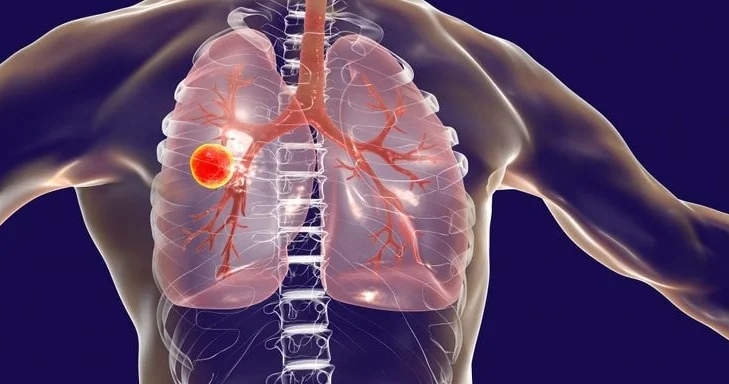 Azərbaycanda vərəmə yoluxanların sayı AZALIB RƏSMİ
