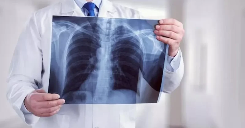 В мире снизилась заболеваемость туберкулезом Впервые с 2020 года