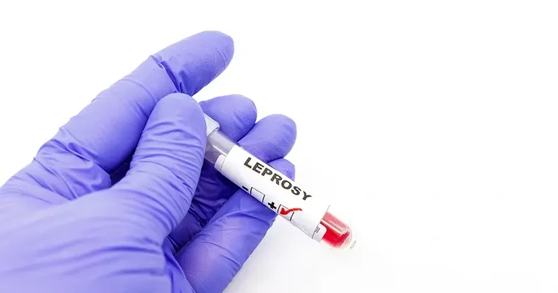 Rumıniyada cüzam xəstəliyi aşkarlanıb