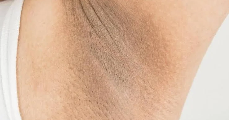 Qolaltı qaralmalar Necə xilas ola bilərik? Həkimdən açıqlama