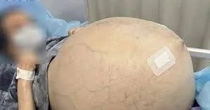 Qadının yumurtalığından 30 kiloqramlıq şiş çıxardılar