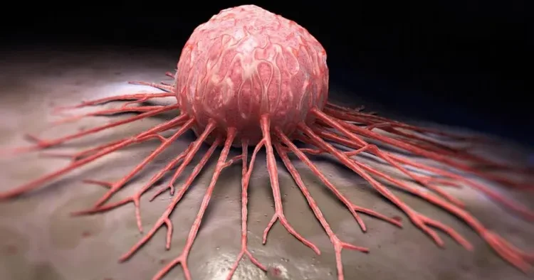 Xərçəngin ilk simptomları nələrdir? Həkimdən açıqlama