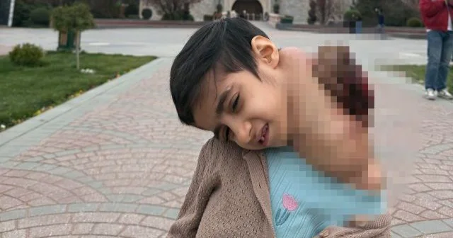 Dünyada ilk Uşağın boynundan 3 kiloqramlıq şiş çıxarıldı