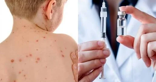 Qızılca əleyhinə peyvənd vurulmayan uşaqlar TƏHLÜKƏDƏ