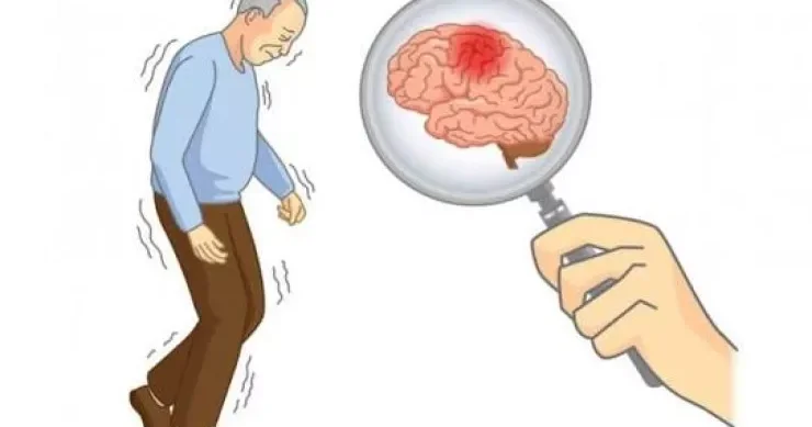 Parkinson xəstəliyi beyində belə yayılırmış