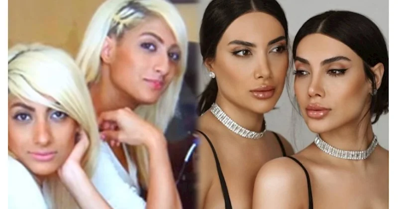 Sevil və Sevincin plastik əməliyyatdan əvvəlki halı VİDEO