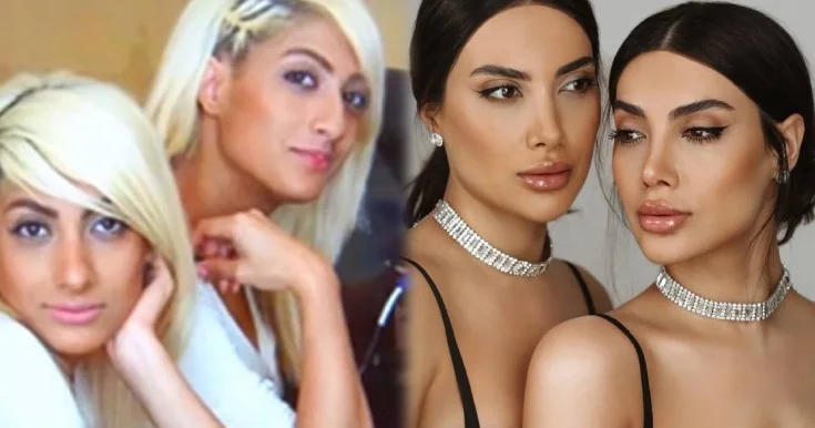 Sevil və Sevincin plastik əməliyyatdan əvvəlki halı Video