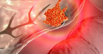 Mədəaltı vəz xərçəngi uzun qızdırma ilə başlaya bilər