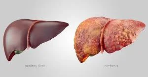 “Qaraciyər sirrozu vaxtında diaqnoz və sağlam həyatla qarşısı alınan təhlükə” ŞƏRH EDİLDİ