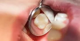 Çox saqqız çeynəmək dişlərdəki plombları boşaldır