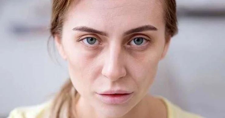 Üzün solğun olması yalnız qanazlığı demək deyil SN nin mütəxəssis eksperti izah edir