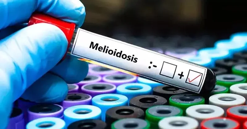 Avstraliyada melioidoz epidemiyasından ölənlərin sayı 31 ə çatıb