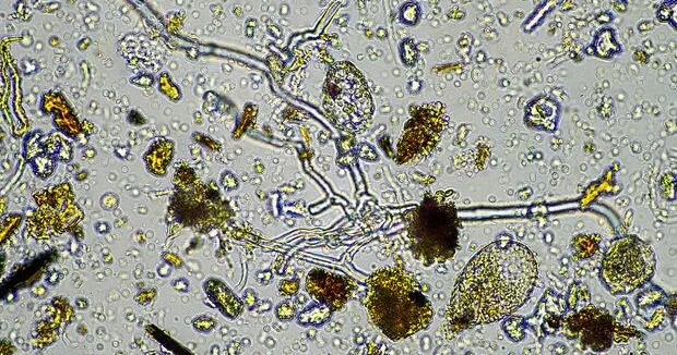 Женщина заразилась неизлечимой болезнью из за стакана водопроводной воды