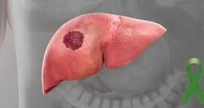 Qaraciyər xərçəngi ilə sirrozun fərqi Onkoloqdan geniş izah