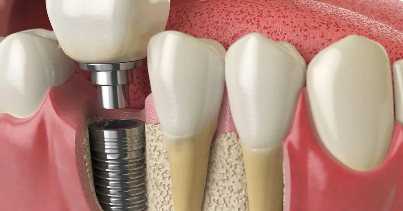Cənubi Koreyada bir gündə 11 diş implantı qoyulan 75 yaşlı qadın öldü