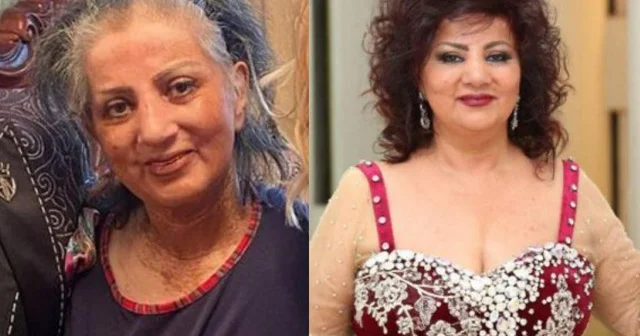 Tanınmış müğənnimiz bu xəstəlikdən vəfat edib SKLERODERMİYA nə ilə təhlükəlidir?
