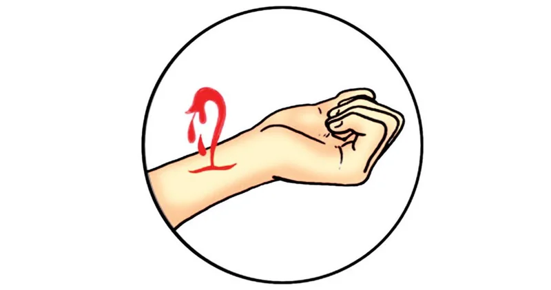 Qanaxma zamanı ilk tibbi yardım necə olmalıdır?