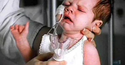 Uşaqlarda nəfəsalma orqanlarının infeksion xəstəlikləri