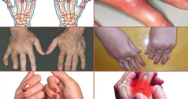 Psoriatik artrit. Simptomlar, diaqnostika, müalicə