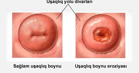 Uşaqlıq boynu eroziyası haqqında yanlış fikirlər