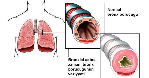 Uşaqlarda bronxial astma xəstəliyi