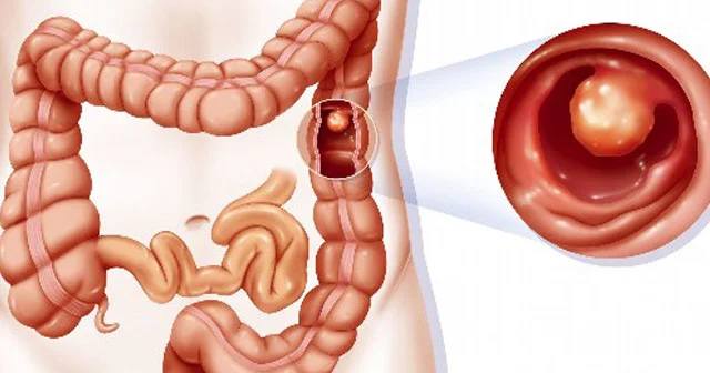 Ən çox kimlər bağırsaq xərçəngi xəstəliyinə tutulurlar?