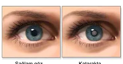Katarakta yayılmış göz xəstəliyi. SƏBƏBLƏRİ
