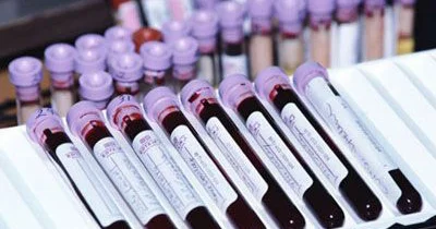 Prolaktinin yüksəlməsi və sonsuzluq