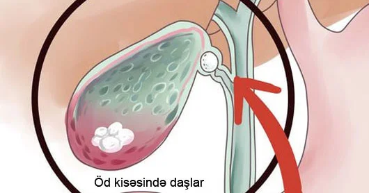 Öd daşı xəstəliyi. Kimlər risk qrupundadır?