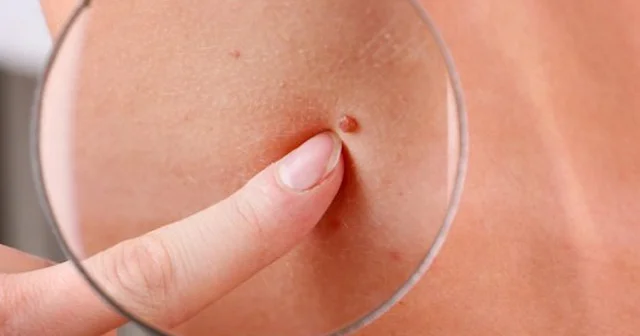 Bədəndəki xalları kəsdirmək təhlükəlidirmi? Dermatoloq açıqladı