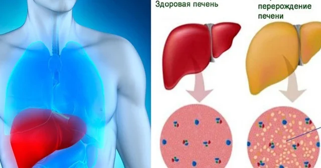 Qaraciyərimizi yağlanmadan necə qoruyaq? TƏBİİ MÜALİCƏ ÜSULLARI