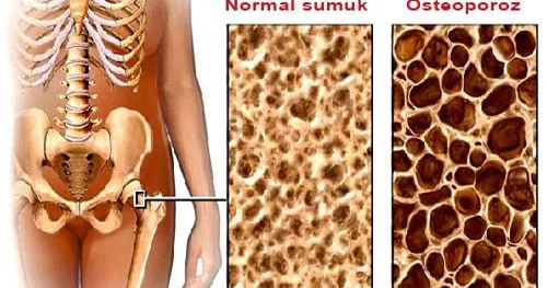 Qadınlarda osteoporoz xəstəliyi və klimaks