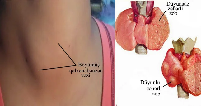 Zobun müalicə ÜSULLARI