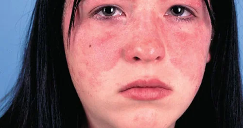Qırmızı qurd eşənəyi (Lupus xəstəliyi). Səbəblər və simptomlar