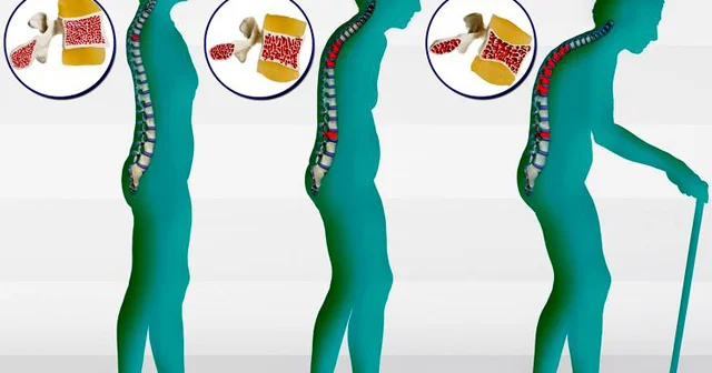 Osteoporoz yaranma səbəbləri və fəsadları