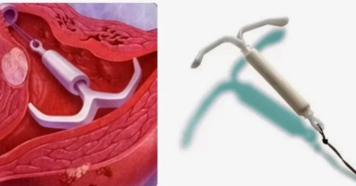 Uşaqlıq daxili spiral kimlərə olmaz?