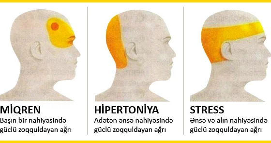 Başağrılarınızın səbəbini müəyyənləşdirin