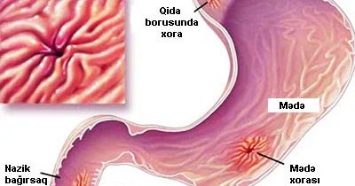 Xora xəstəliyinin simptomları