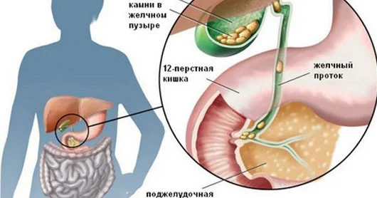 Öd kisəsində daşlar BU SƏBƏBLƏRƏ GÖRƏ əmələ gəlir