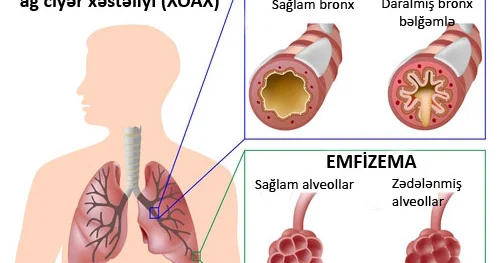 Siqaret çəkənlərin qənimi xroniki obstruktiv ağ ciyər xəstəliyi