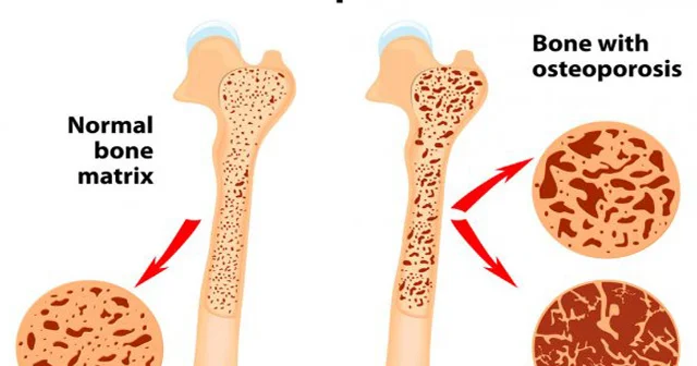 OSTEOPOROZ. Səbəblər və profilaktik tədbirlər