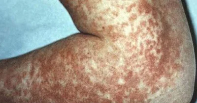 Ebola virusu. Qorxmaq lazımdırmı?