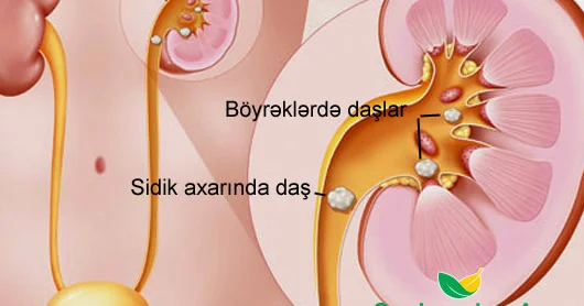 Sidik daşı xəstəliyi. Səbəblər, profilaktika və TƏBİİ ÇARƏLƏR