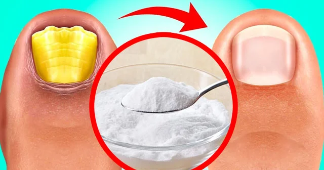 Dırnaq göbələyinin XALQ TƏBABƏTİ vasitələri ilə müalicəsi VİDEO
