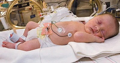 Vaxtından qabaq doğulmuş uşaqların problemləri