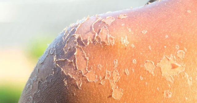 Zaqardan sonra dəriniz soyulursa, bunları edin DERMATOLOQ TÖVSİYƏSİ