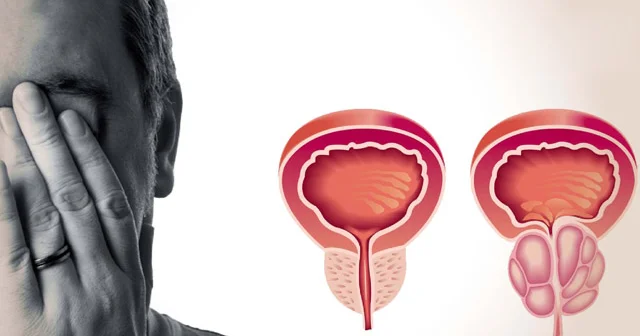 Prostatit vaxtında müalicə olunmalıdır FOTO