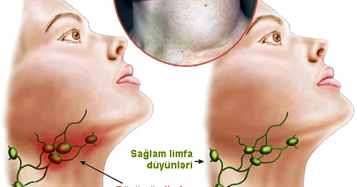 Limfa düyünləri böyüyübsə, həkimə müraciət edin. Bu xərçəng ola bilər!