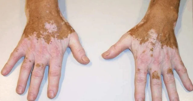Vitiliqo xəstəliyindən əziyyət çəkənlərə şad xəbər Dermatoloq açıqladı
